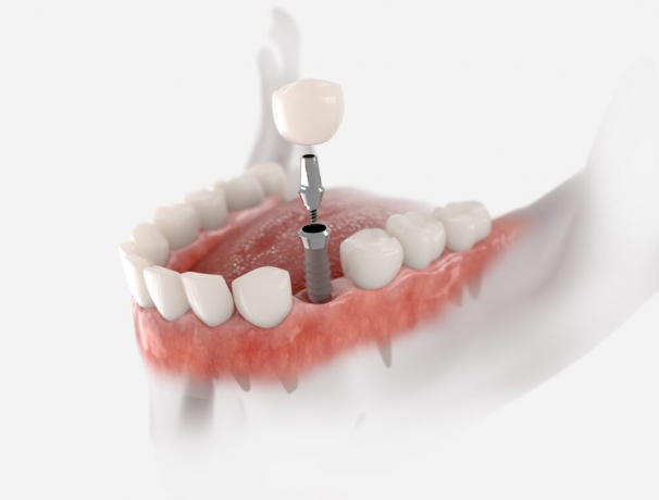 Dental Implants in Plano, TX: A Comprehensive Guide