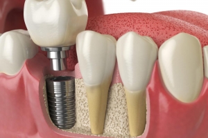What is the Definition of a Single-Tooth Dental Implant?